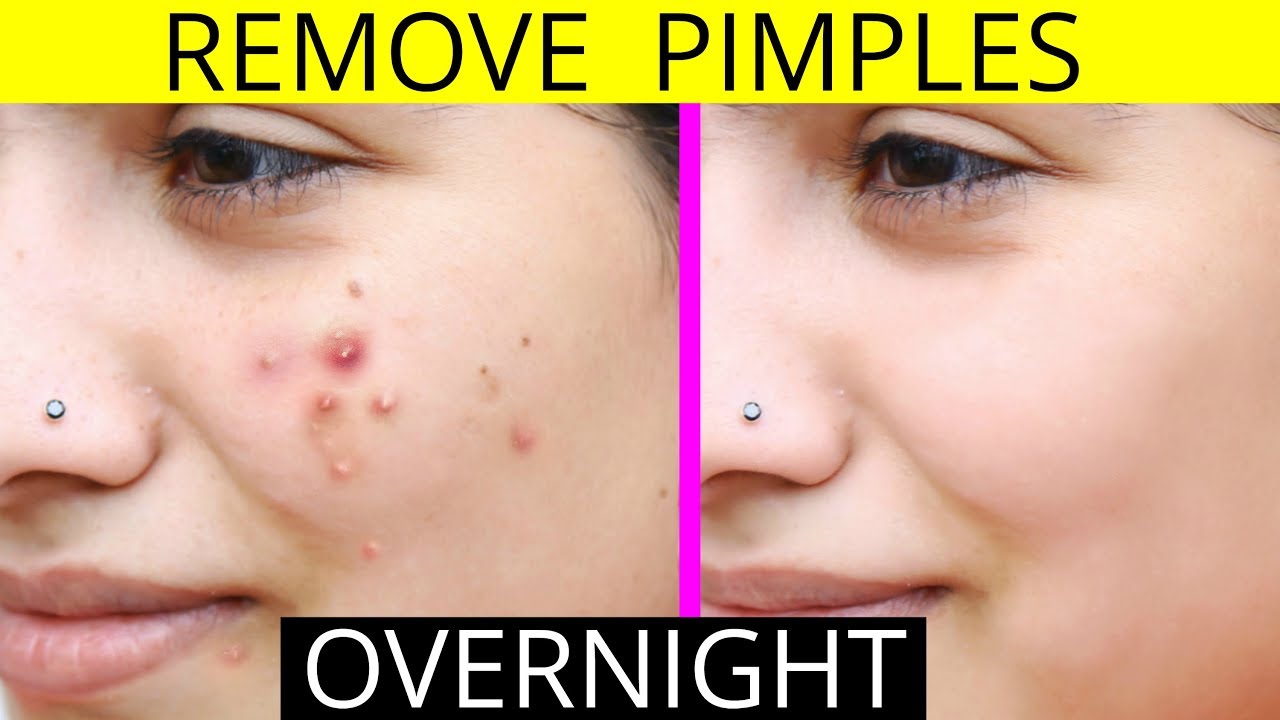 How to remove pimples overnight