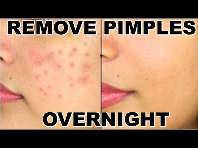 Pimple removal techniques